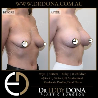 BREAST AUGMENTATION 

Experience & Excellence in Plastic Surgery is what you deserve.

#BreastImplants #DrEddyDona #PlasticSurgery #BreastAugmentation

All surgery carries risks. You can learn more by visiting our website - link can be found in our
bio.
Or go to http://www.drdonaplasticsurgery.com.au/surgery-risks/

DISCLAIMER: All surgeries on this page are performed by Dr Eddy Dona and are published with the written consent by the patients.
After images are generally taken between 3-6 months post-surgery.
All surgery requires recovery time.
The outcomes shown are only relevant for this patient and do not necessarily reflect the results other patients may experience, even if they have a similar body type or shape.
Results may vary due to many factors including an individual’s genetics and lifestyle.
The content on this page is general in nature and is not a substitute for a formal consultation.
Before proceeding, please seek medical advice from an appropriately qualified medical practitioner.
Dr Eddy Dona is a Specialist Plastic Surgeon
(Registration: MED0001177175)